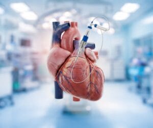 Cardiologie interventionnelle