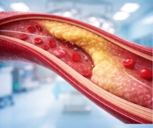 SpireWire® Fil de guidage PTCA