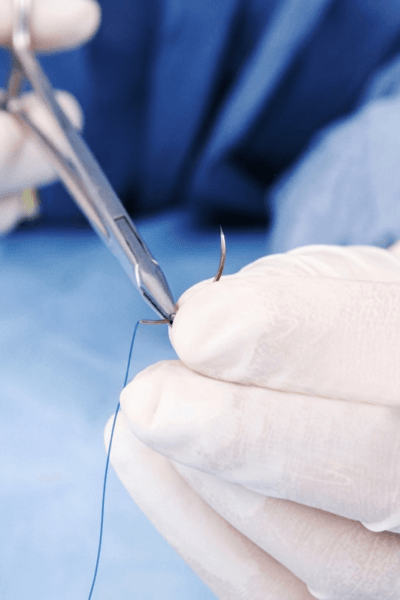 sutures